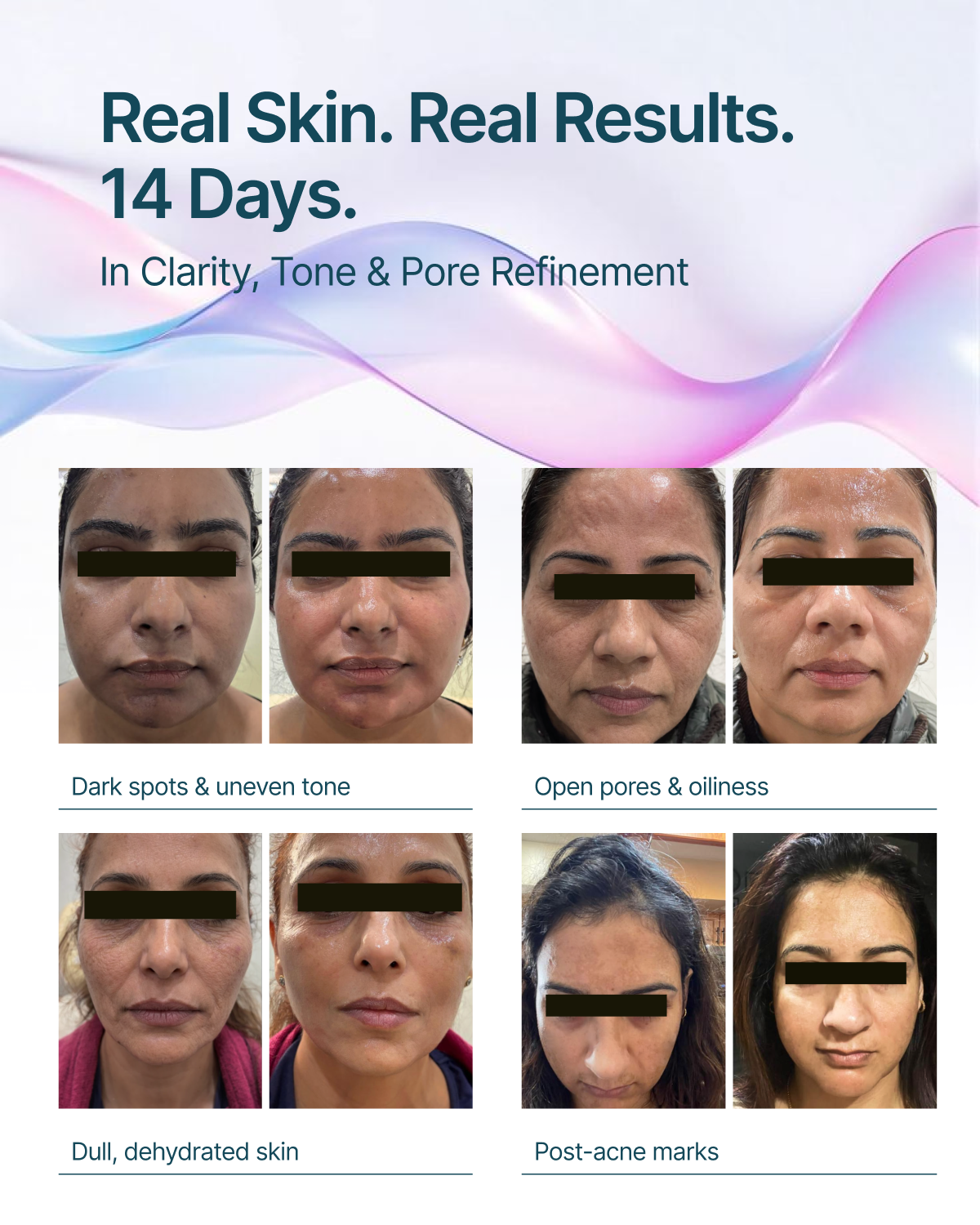 Glow Forever.. 14-Day Dark Spot & Pore Refining Serum