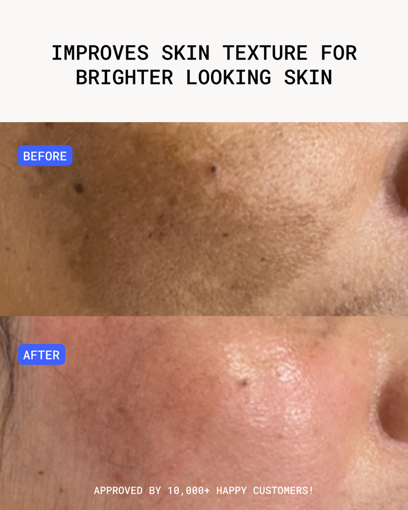 12-Week Pigmentation Treatment - alt view