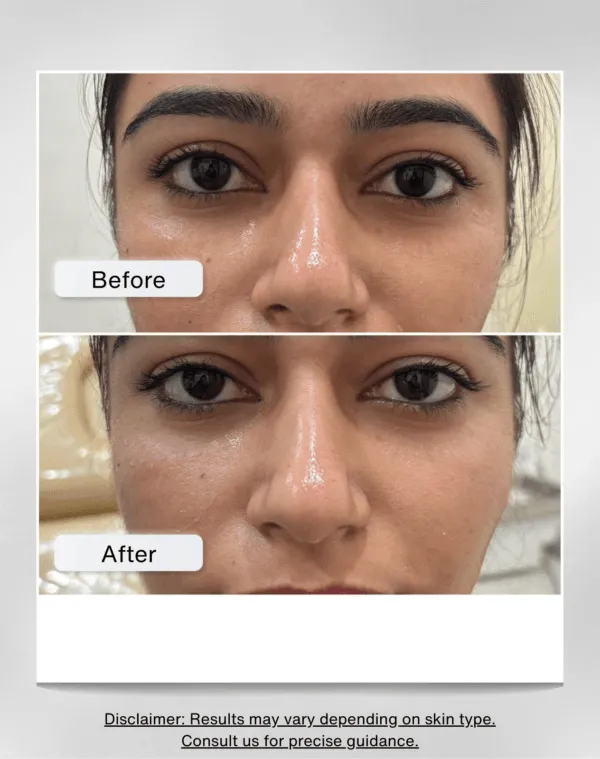 Eye Revive | Serum for Under Eye Puffiness , Dark Circles and Wrinkles | Hyaluronic Acid - Image 2